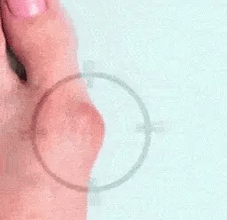 Paire de Correcteur Hallux Valgus en Silicone