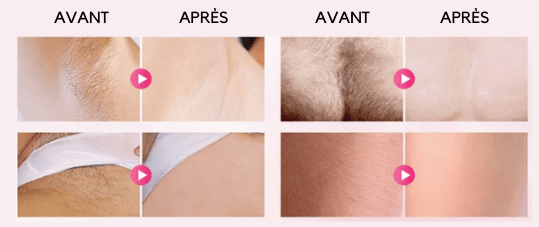 Épilateur laser permanent