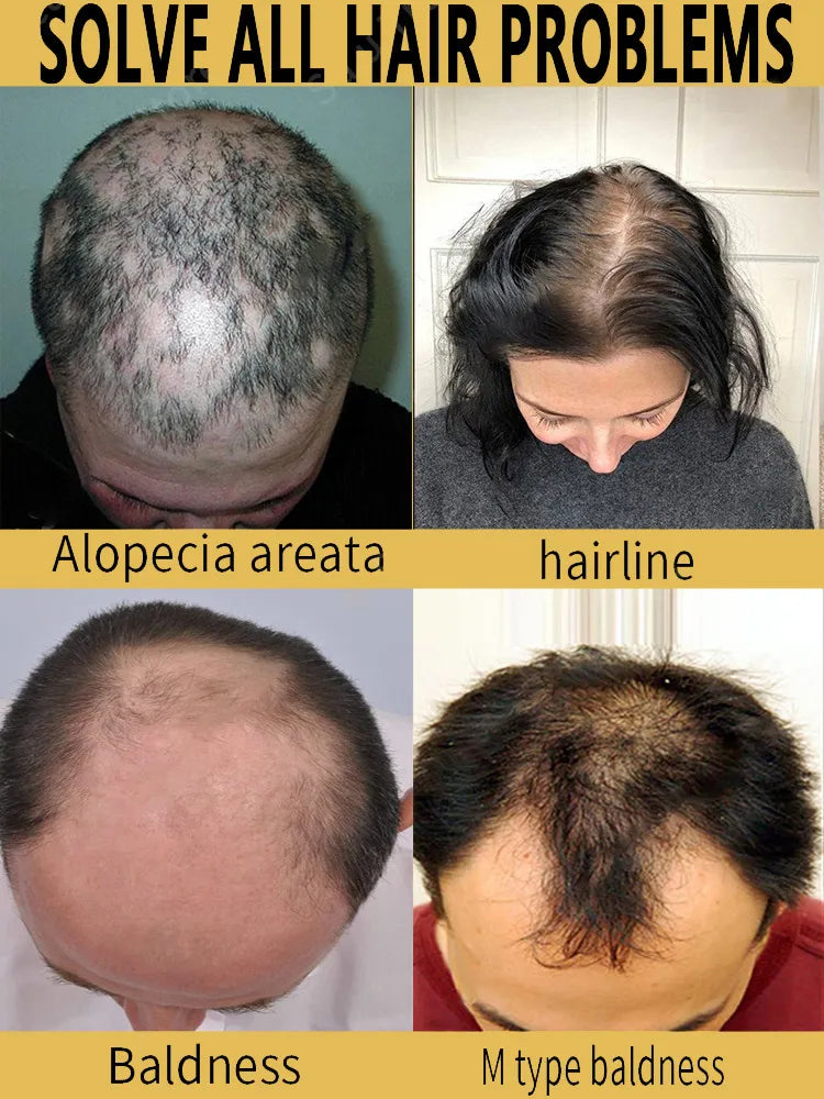 Huile de croissance rapide des cheveux - 2 ACHETÉE = 1 OFFERTE